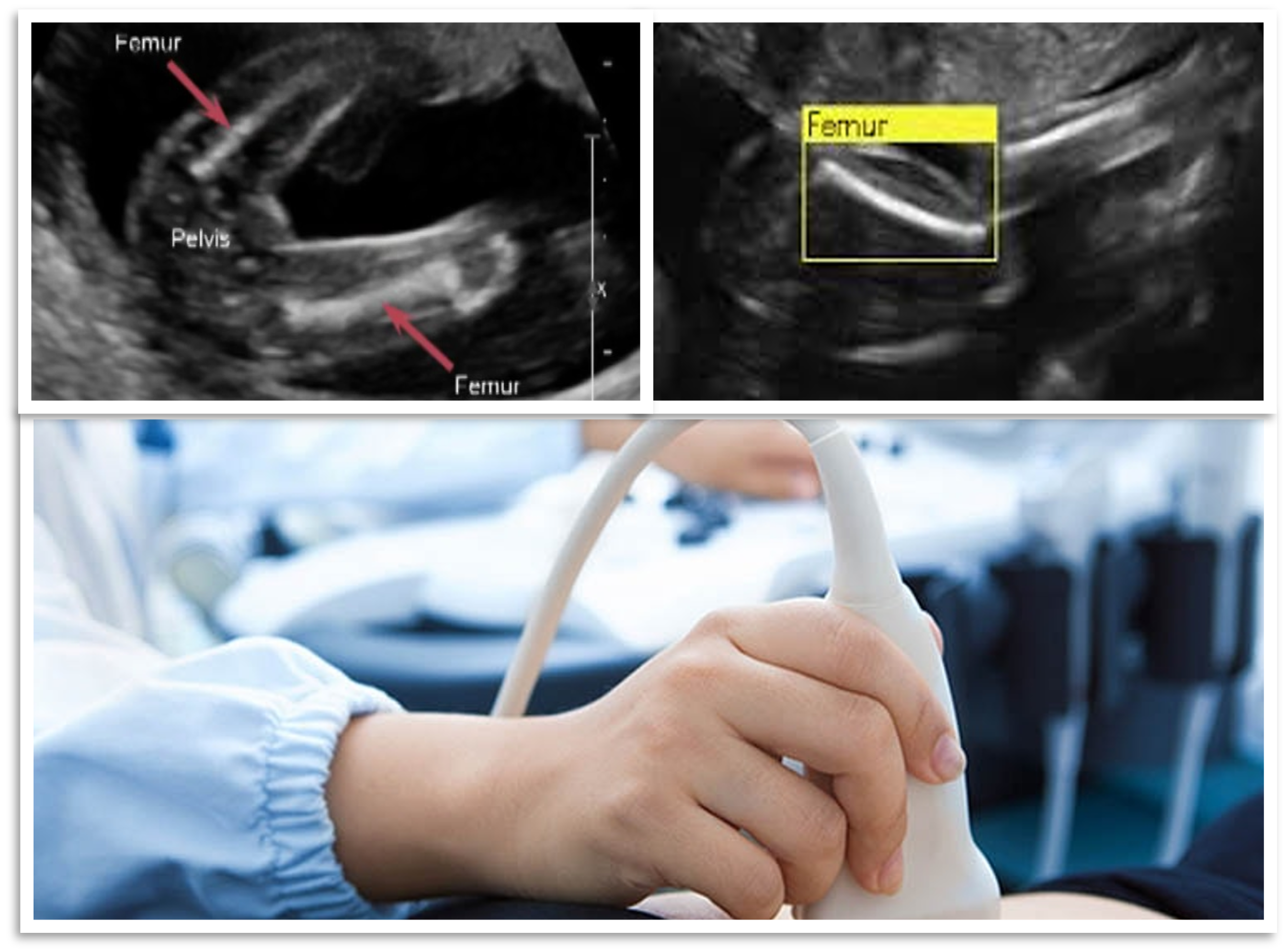 Sonography Femur Detection